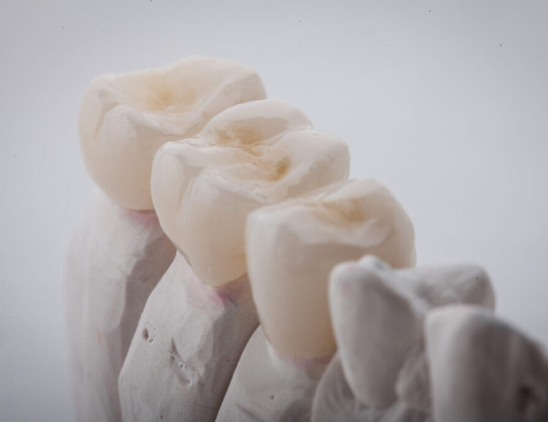 八千代緑が丘駅より徒歩1分の歯医者、公園都市プラザわかば歯科の歯ぎしり、食いしばり