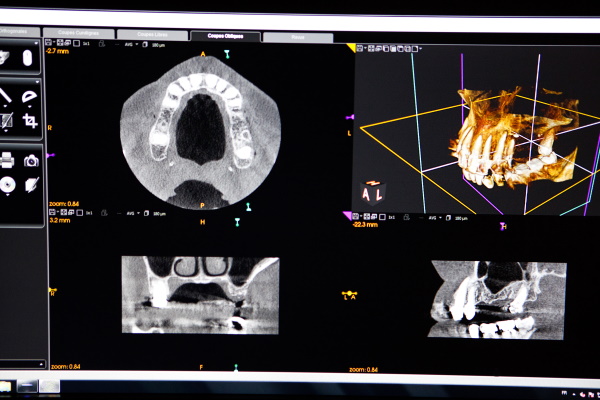 千葉県茂原市の歯医者、たけ歯科クリニックの自家歯牙移植