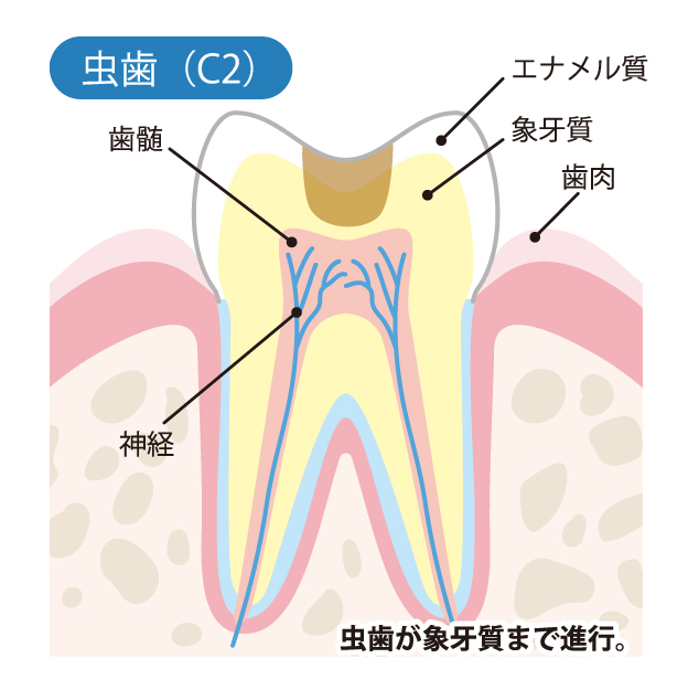 千葉県茂原市の歯医者、たけ歯科クリニックのむし歯治療