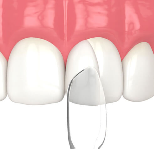 千葉県茂原市の歯医者、たけ歯科クリニックの審美歯科治療