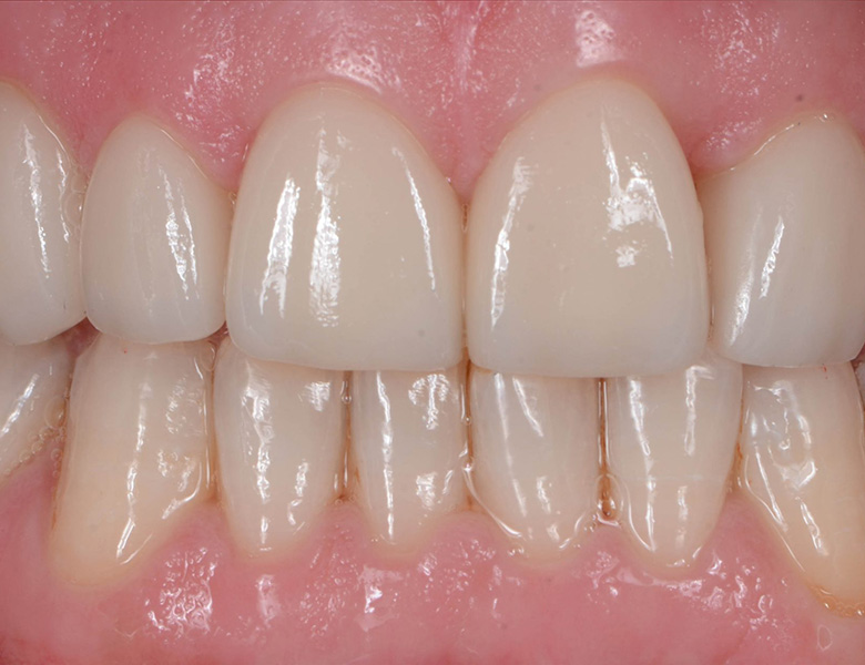 千葉県茂原市の歯医者、たけ歯科クリニックのなるべく削らず、歯を守る治療