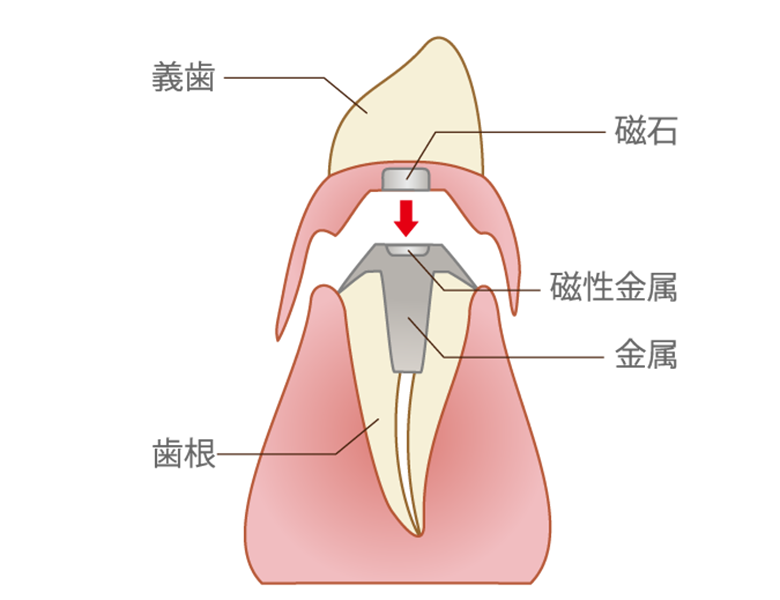 千葉県茂原市の歯医者、たけ歯科クリニックの入れ歯治療