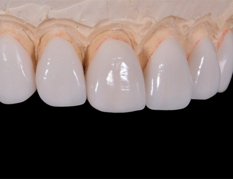 千葉県茂原市の歯医者、たけ歯科クリニックのマイクロスコープ精密治療