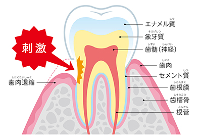 千葉県茂原市の歯医者、たけ歯科クリニックの歯ぎしり、食いしばり