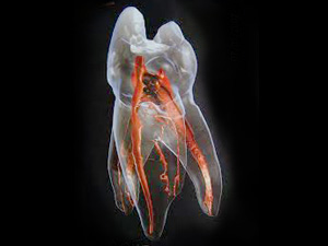 千葉県茂原市の歯医者、たけ歯科クリニックの根管治療