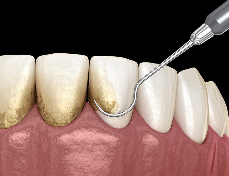 千葉県茂原市の歯医者、たけ歯科クリニックの歯周病治療