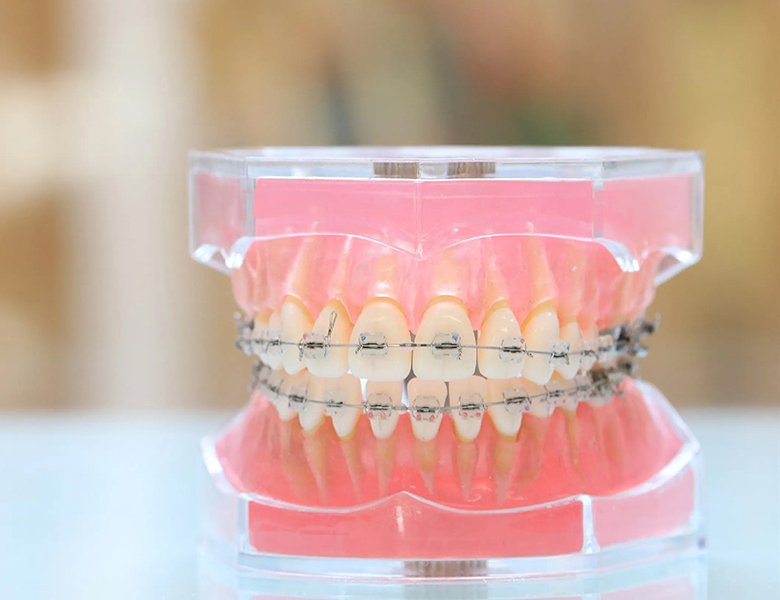 八千代緑が丘駅より徒歩1分の歯医者、公園都市プラザわかば歯科の矯正歯科