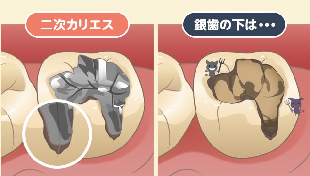 千葉県茂原市の歯医者、たけ歯科クリニックのむし歯治療