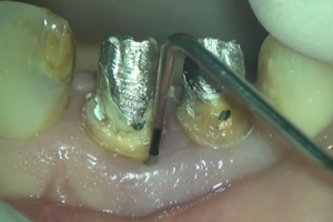 千葉県茂原市の歯医者、たけ歯科クリニックのマイクロスコープ精密治療